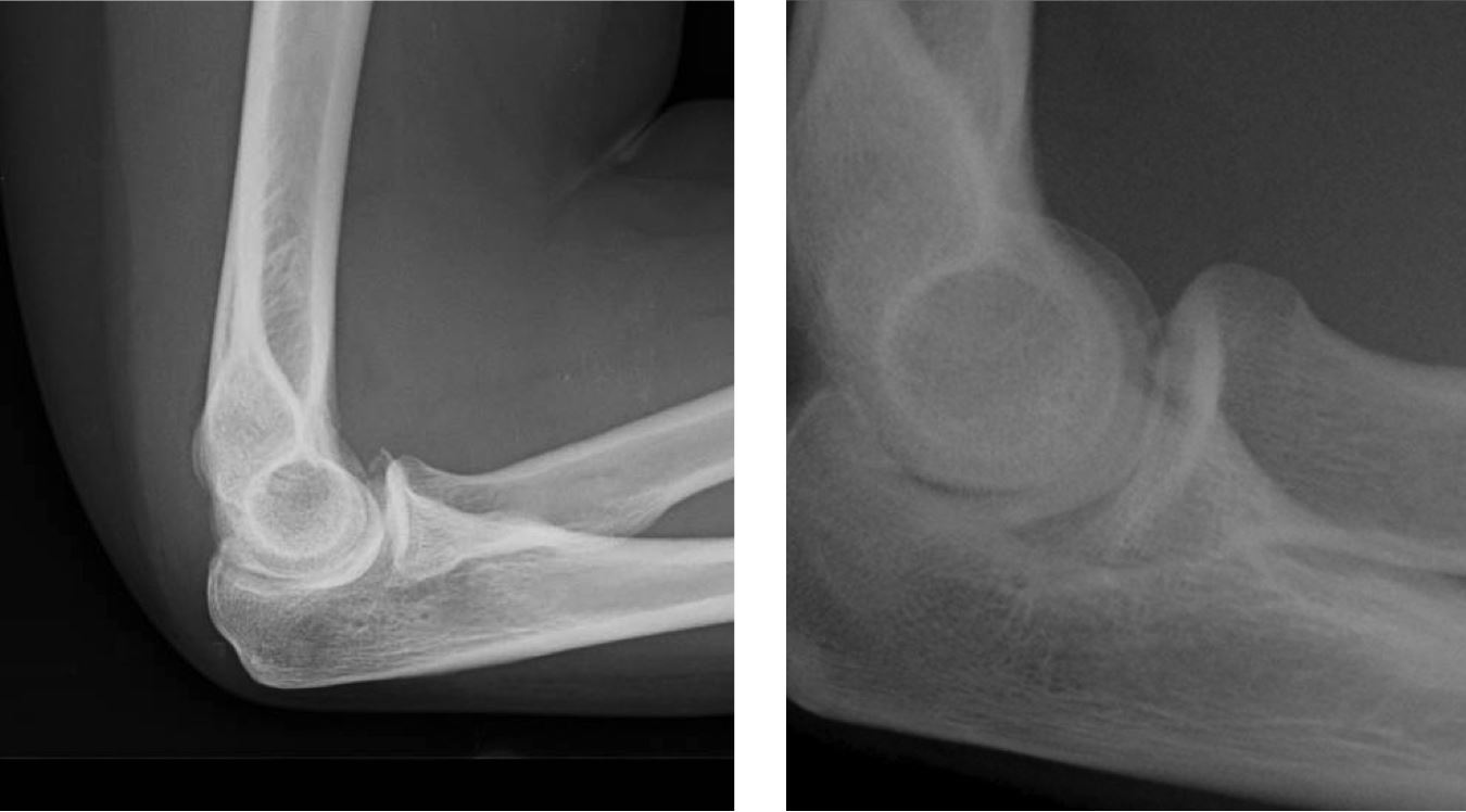 Coronoid Process Of Ulna Fracture